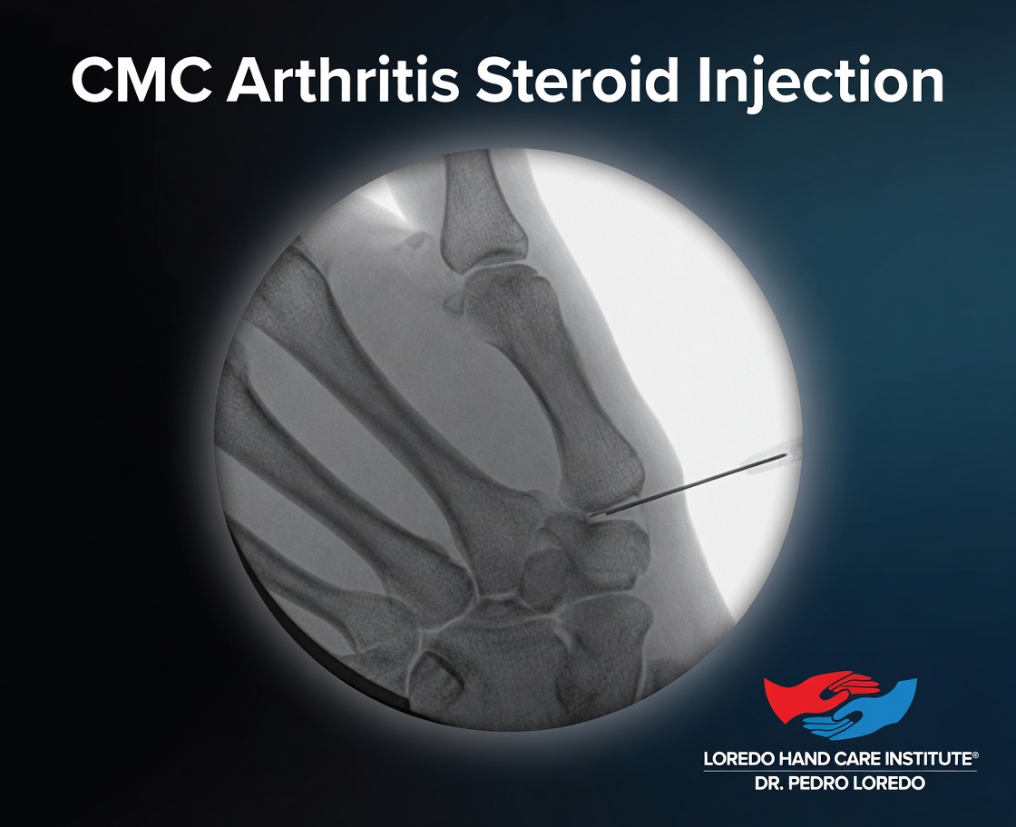 CMC arthritis fluoroscopy-guided steroid injection X-ray image showing the precise needle placement into the thumb CMC joint space confirmed by live fluoroscopic imaging. Created for Loredo Hand Care Institute by Dr. Pedro Loredo.